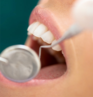 Periodontal Maintenance Dental Services
