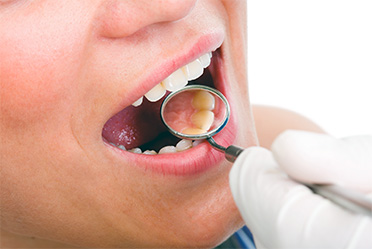 Scaling and Root Planing Dental Services