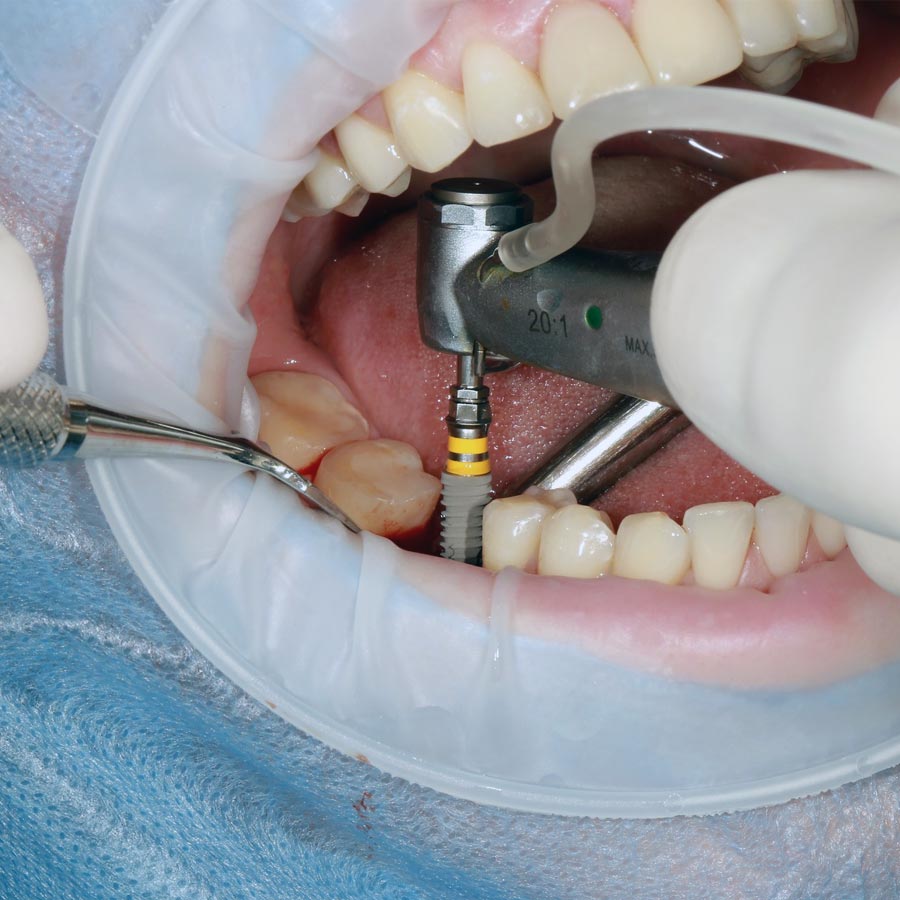 Dentist performing oral surgery